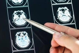 Ecco come il Long Covid cambia il cervello con meccanismi tipici dell'Alzheimer Ecco come il Long Covid cambia il cervello con meccanismi tipici dell'Alzheimer