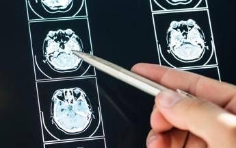 Ecco come il Long Covid cambia il cervello con meccanismi tipici dell'Alzheimer Ecco come il Long Covid cambia il cervello con meccanismi tipici dell'Alzheimer