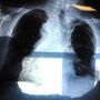 Bpco, pazienti e Cittadinanzattiva: "Aggiornamento Nota 99 favorisce cure eque"
