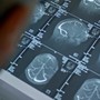 Fenilchetonuria, 'screening neonatale evita danni neurologici ma serve continuità assistenziale' Fenilchetonuria, 'screening neonatale evita danni neurologici ma serve continuità assistenziale'