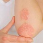 Giornata psoriasi, Ucb rinnova l'impegno contro lo stigma Giornata psoriasi, Ucb rinnova l'impegno contro lo stigma