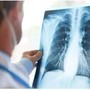 Cancro polmone Egfr-mutato, studio fase 3 Adaura: "Il 79% dei pazienti vivo a 8 anni con Osimertinib"