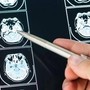 Intelligenza Artificiale può prevedere evoluzione Parkinson, lo studio italiano