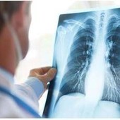 Cancro polmone Egfr-mutato, studio fase 3 Adaura: "Il 79% dei pazienti vivo a 8 anni con Osimertinib"