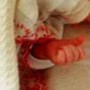 Torino, neonata salvata da rara malformazione al fegato con colla istantanea