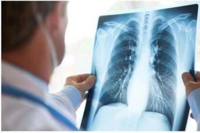 Cancro polmone Egfr-mutato, studio fase 3 Adaura: "Il 79% dei pazienti vivo a 8 anni con Osimertinib"
