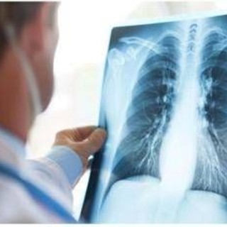 Cancro polmone Egfr-mutato, studio fase 3 Adaura: "Il 79% dei pazienti vivo a 8 anni con Osimertinib" Cancro polmone Egfr-mutato, studio fase 3 Adaura: "Il 79% dei pazienti vivo a 8 anni con Osimertinib"