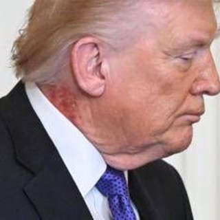 Trump e il collo arrossato, la foto riaccende i dubbi sulla salute del presidente Trump e il collo arrossato, la foto riaccende i dubbi sulla salute del presidente