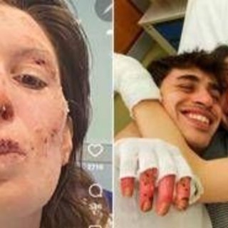 Crans-Montana, oggi dimessi due ragazzi. Eleonora Palmieri mostra le ustioni sui social Crans-Montana, oggi dimessi due ragazzi. Eleonora Palmieri mostra le ustioni sui social