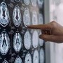 Stop tremori Parkinson senza bisturi, 10 pazienti curati con ultrasuoni a Napoli Stop tremori Parkinson senza bisturi, 10 pazienti curati con ultrasuoni a Napoli